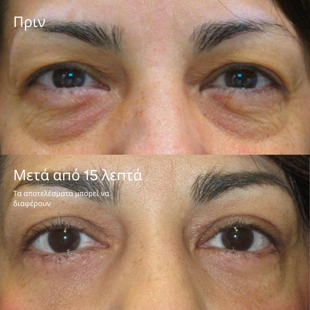 24K Gold Eye Mask για Ξεκούραστο & Αφυπνισμένο Βλέμμα