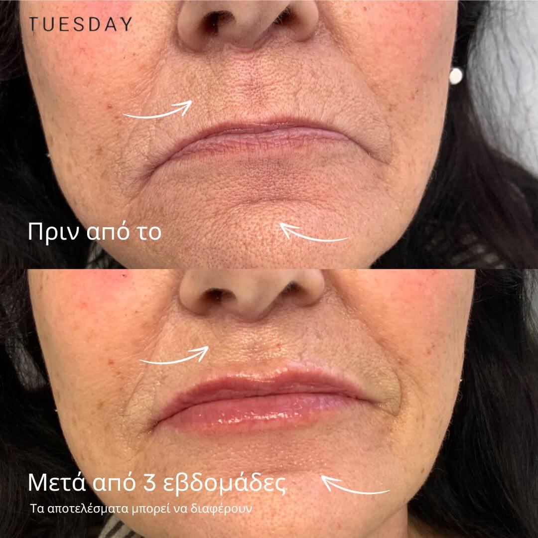 Ορός αντιγήρανσης από χρυσό 24Κ