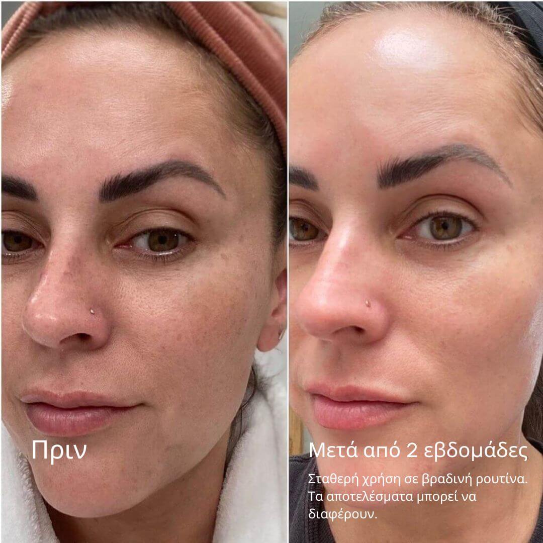 Ανανεωτική Συσφικτική Φροντίδα με Ρετινάλη