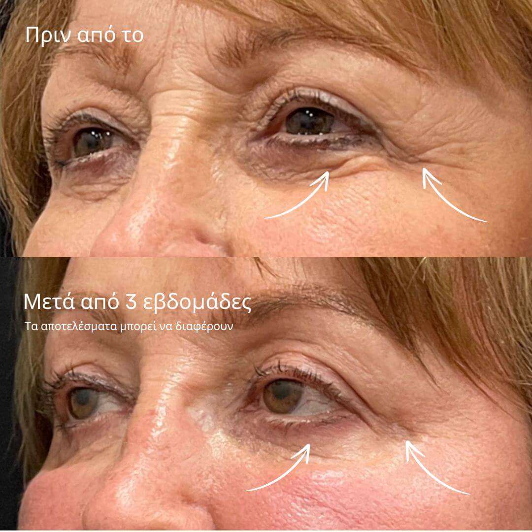 GlowLift Ρετινόλη Στικ Ματιών